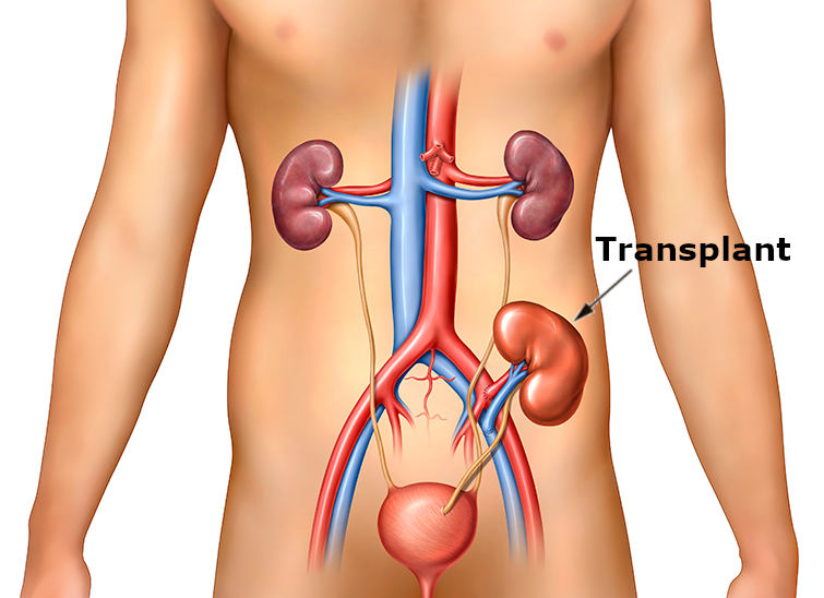 Kidney-Transplant-Graphic