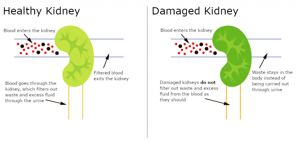 Learn More About Kidney Disease - DialysisReadyDialysisReady Learn More About Kidney Disease - DialysisReadyDialysisReady